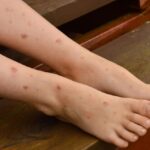 Insect Bites & Urticaria